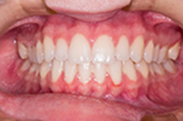 healthy gums