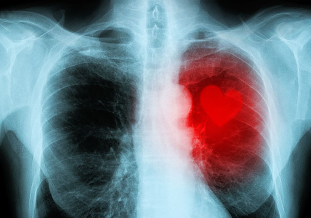 Rhuematic Disease