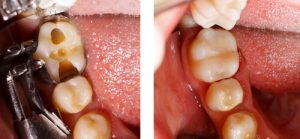 Amalgam Fillings Vs Composite Fillings For Tooth Cavities