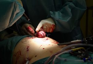 Kidney Removal Surgery
