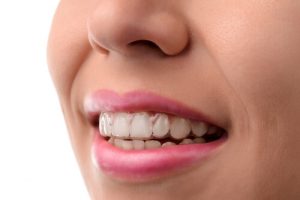 invisalign tips