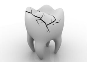 Cracked tooth Cracked tooth