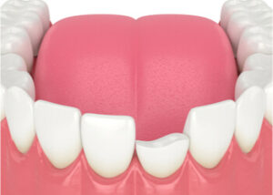 Broken teeth Broken teeth