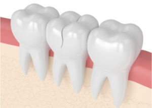 Broken tooth Broken tooth