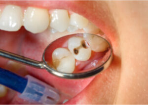 Premolar cavities