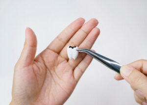 Cavity on molars