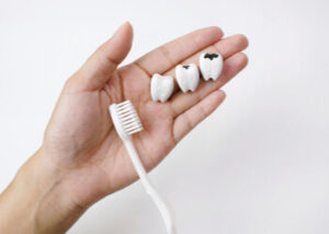 Tooth decay stages