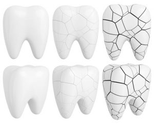 tooth decay black lines on teeth